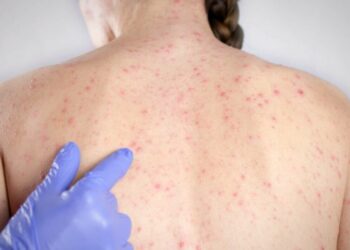 Cazuri de rujeolă, înregistrate în rândul cetățenilor care se întorc din vacanța din Bukovel