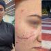 O adolescentă din Orhei beneficiază de o operație gratuită după un accident rutier