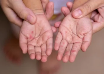 Focar de rujeolă în Cimișlia: 8 copii infectați