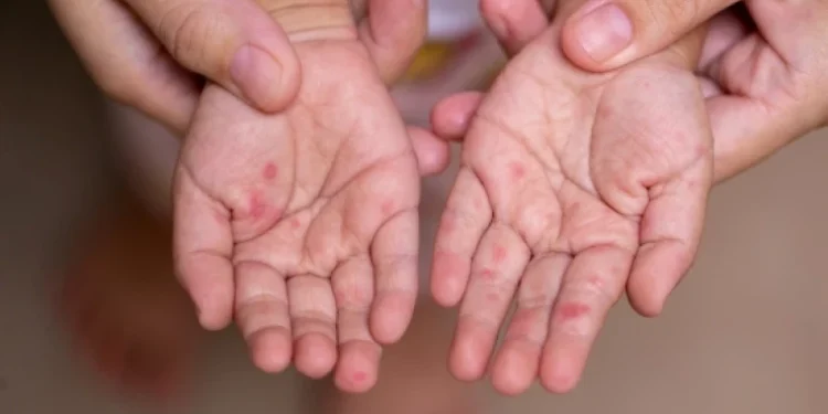 Focar de rujeolă în Cimișlia: 8 copii infectați