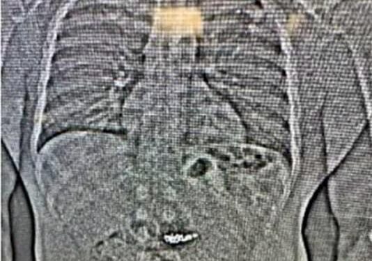 Jaythan Gilder, prins cu bijuterii furate în stomac, după un jaf la Tiffany & Co.