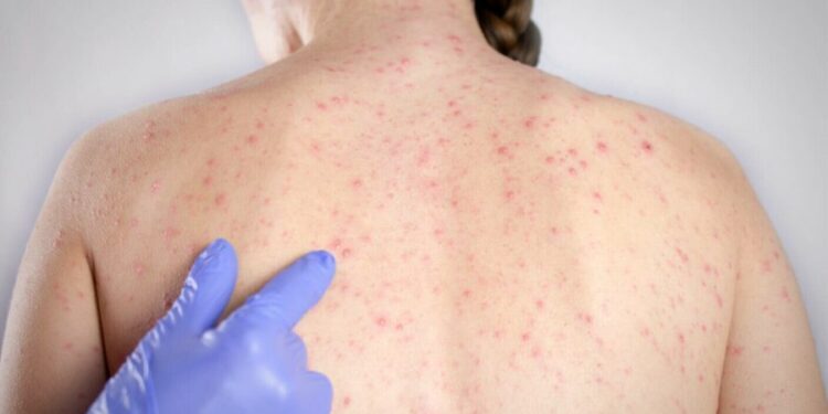 Un focar de rujeolă a fost înregistrat în raionul Cimișlia. Câți copii s-a îmbolnăvit